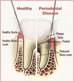 Periodontal-disease-illustration