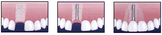 Implant-Placement-illustration